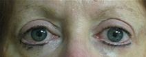 Eyelid Surgery After Photo by Neal Goldberg, MD; Scarsdale, NY - Case 10496