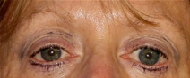 Eyelid Surgery Before Photo by Neal Goldberg, MD; Scarsdale, NY - Case 10496