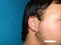 Ear Surgery After Photo by Moneer Jaibaji, MD; ,  - Case 20275