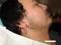 Ear Surgery Before Photo by Moneer Jaibaji, MD; ,  - Case 20275