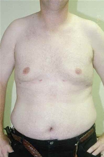 Male Breast Reduction After Photo by Randy Proffitt, MD; Mobile, AL - Case 21833