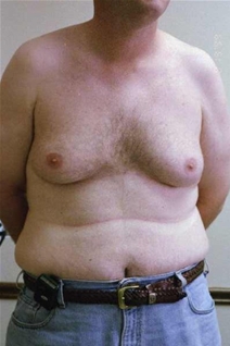Male Breast Reduction Before Photo by Randy Proffitt, MD; Mobile, AL - Case 21833
