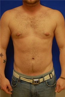 Male Breast Reduction After Photo by Randy Proffitt, MD; Mobile, AL - Case 22094
