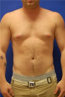 Male Breast Reduction Before Photo by Randy Proffitt, MD; Mobile, AL - Case 22094