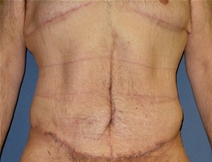 Body Contouring After Photo by Neal Goldberg, MD; Scarsdale, NY - Case 22334