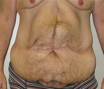 Body Contouring Before Photo by Neal Goldberg, MD; Scarsdale, NY - Case 22334