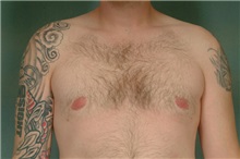 Male Breast Reduction After Photo by Robert Zubowski, MD; ,  - Case 23731