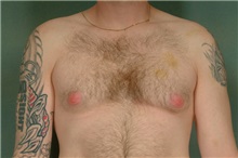 Male Breast Reduction Before Photo by Robert Zubowski, MD; ,  - Case 23731