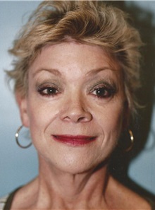 Facelift After Photo by Kristoffer Ning Chang, MD; ,  - Case 24693