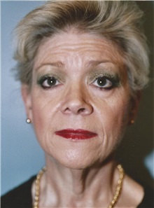 Facelift Before Photo by Kristoffer Ning Chang, MD; ,  - Case 24693