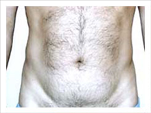Liposuction Before Photo by David Abramson, MD; Englewood, NJ - Case 25321