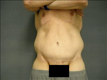 Body Contouring After Photo by Ellen Janetzke, MD; Bloomfield Hills, MI - Case 25508