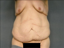 Body Contouring Before Photo by Ellen Janetzke, MD; Bloomfield Hills, MI - Case 25508