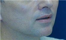 Dermal Fillers After Photo by Ricardo Rodriguez, MD; Lutherville-Timonium, MD - Case 27035