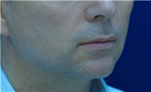 Dermal Fillers Before Photo by Ricardo Rodriguez, MD; Lutherville-Timonium, MD - Case 27035