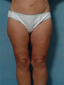 Body Contouring After Photo by Ellen Janetzke, MD; Bloomfield Hills, MI - Case 27264