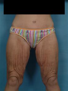 Body Contouring Before Photo by Ellen Janetzke, MD; Bloomfield Hills, MI - Case 27264