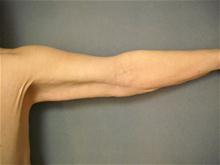 Arm Lift After Photo by Ellen Janetzke, MD; Bloomfield Hills, MI - Case 27523