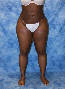 Liposuction After Photo by Wendell Perry, MD; North Miami Beach, FL - Case 27733