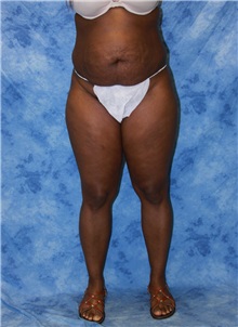 Liposuction Before Photo by Wendell Perry, MD; North Miami Beach, FL - Case 27733