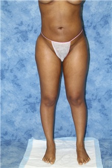 Liposuction After Photo by Wendell Perry, MD; North Miami Beach, FL - Case 27765