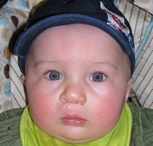 Cleft Lip and Palate Repair After Photo by Rachel Ruotolo, MD; Garden City, NY - Case 28007
