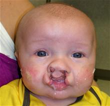 Cleft Lip and Palate Repair Before Photo by Rachel Ruotolo, MD; Garden City, NY - Case 28007