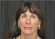 Facelift After Photo by Andrew Smith, MD; ,  - Case 28693