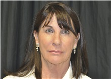 Facelift Before Photo by Andrew Smith, MD; ,  - Case 28693