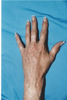 Dermal Fillers After Photo by Kristoffer Ning Chang, MD; ,  - Case 29764