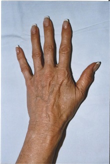 Dermal Fillers Before Photo by Kristoffer Ning Chang, MD; ,  - Case 29764