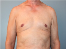 Male Breast Reduction After Photo by Larry Nichter, MD; ,  - Case 29836