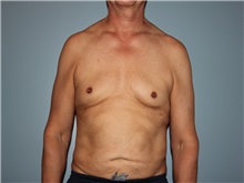 Male Breast Reduction Before Photo by Larry Nichter, MD; ,  - Case 29836