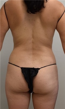 Buttock Lift with Augmentation Before Photo by Meegan Gruber, MD, PhD; Tampa, FL - Case 29922