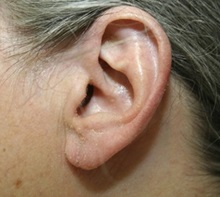 Ear Surgery After Photo by Timothy Mountcastle, MD; ashburn, VA - Case 29997