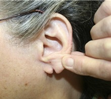 Ear Surgery Before Photo by Timothy Mountcastle, MD; ashburn, VA - Case 29997