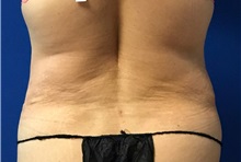 Liposuction After Photo by Timothy Mountcastle, MD; ashburn, VA - Case 30101