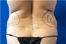Liposuction Before Photo by Timothy Mountcastle, MD; ashburn, VA - Case 30101