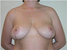 Breast Lift After Photo by Steven Pisano, MD; ,  - Case 30111