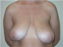 Breast Lift Before Photo by Steven Pisano, MD; ,  - Case 30111