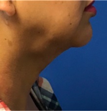 Liposuction After Photo by Timothy Mountcastle, MD; ashburn, VA - Case 30161