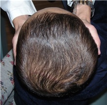 Craniosynostosis After Photo by Rachel Ruotolo, MD; Garden City, NY - Case 30311