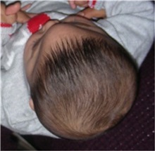 Craniosynostosis Before Photo by Rachel Ruotolo, MD; Garden City, NY - Case 30311