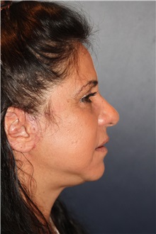 Facelift After Photo by Larry Weinstein, MD; Chester, NJ - Case 30654