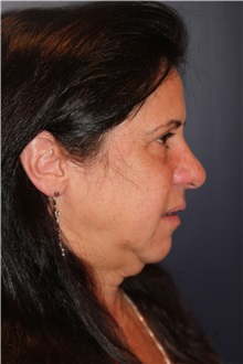 Facelift Before Photo by Larry Weinstein, MD; Chester, NJ - Case 30654