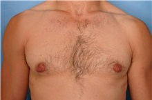 Male Breast Reduction After Photo by Kent Hasen, MD; Naples, FL - Case 30700