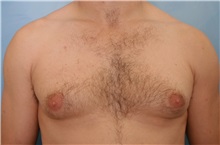 Male Breast Reduction Before Photo by Kent Hasen, MD; Naples, FL - Case 30700