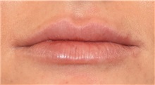 Lip Augmentation/Enhancement After Photo by Richard Reish, MD, FACS; New York, NY - Case 30969