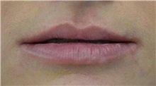 Lip Augmentation/Enhancement Before Photo by Richard Reish, MD, FACS; New York, NY - Case 30969