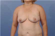 Breast Reconstruction Before Photo by Trent Douglas, MD; Knoxville, TN - Case 31406